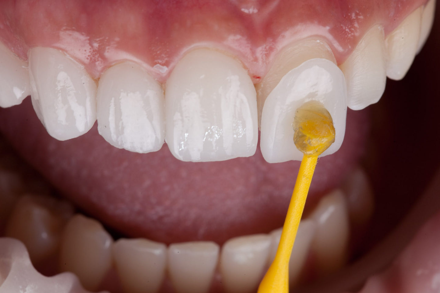 Dubai - One Enamel Veneer Repair Voucher – By 16Teeth Specialists