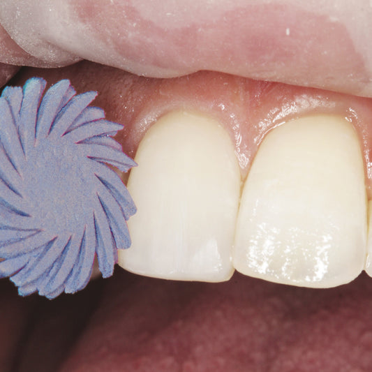 Dubai- One Enamel Veneer Cleaning & Polishing Voucher – By 16Teeth Specialists