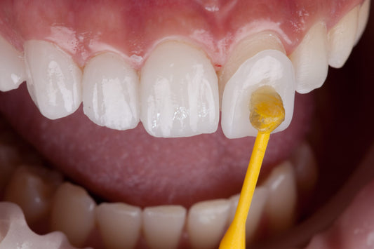Dubai - One Enamel Veneer Repair Voucher – By 16Teeth Specialists